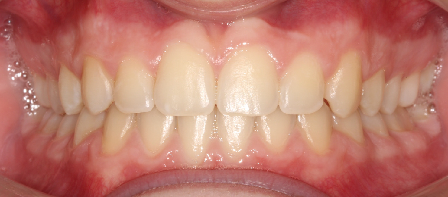 After image