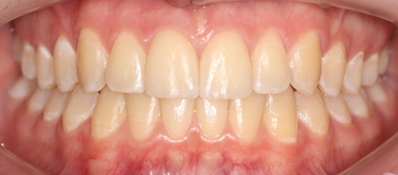 After image